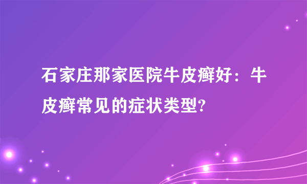 石家庄那家医院牛皮癣好：牛皮癣常见的症状类型?