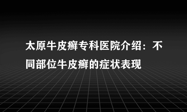 太原牛皮癣专科医院介绍：不同部位牛皮癣的症状表现