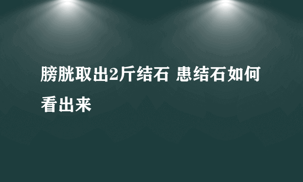 膀胱取出2斤结石 患结石如何看出来