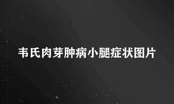 韦氏肉芽肿病小腿症状图片