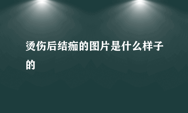 烫伤后结痂的图片是什么样子的