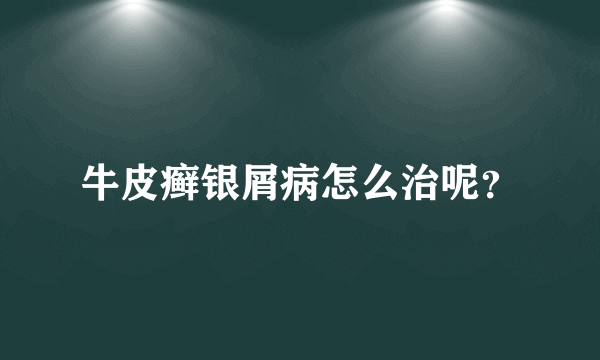 牛皮癣银屑病怎么治呢？