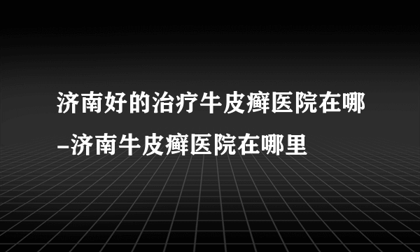 济南好的治疗牛皮癣医院在哪-济南牛皮癣医院在哪里