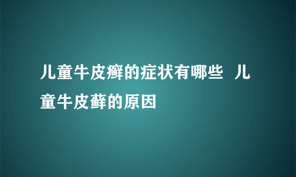 儿童牛皮癣的症状有哪些  儿童牛皮藓的原因