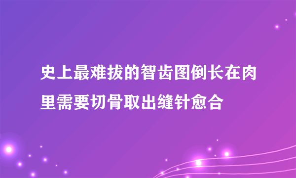 史上最难拔的智齿图倒长在肉里需要切骨取出缝针愈合