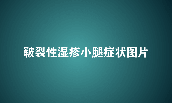 皲裂性湿疹小腿症状图片