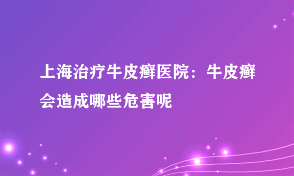 上海治疗牛皮癣医院：牛皮癣会造成哪些危害呢