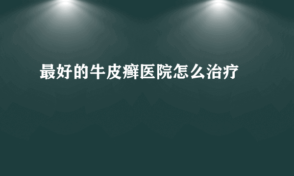 最好的牛皮癣医院怎么治疗 